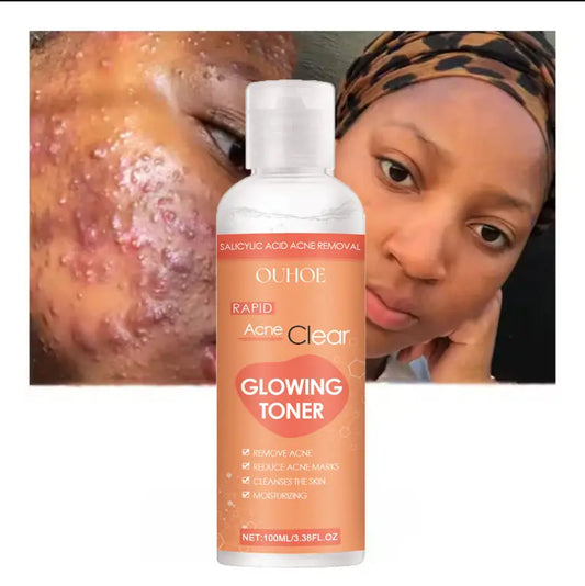 Tonique nettoyant doux pour le visage contre l'acné et les taches